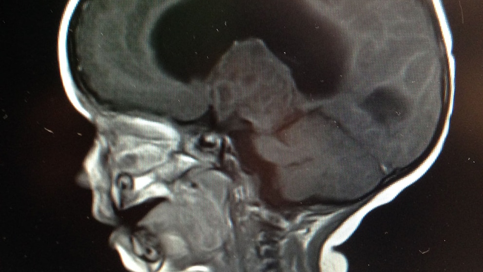 <strong>Eine MRT-Bildgebung gibt Gewissheit: Der helle Bereich in der Mitte des Gehirns zeigt Bjarnes Tumor, der dunkle Bereich darüber zeigt das Stammhirn</strong>